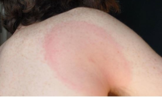 Typical Lyme disease rash, lighter skin